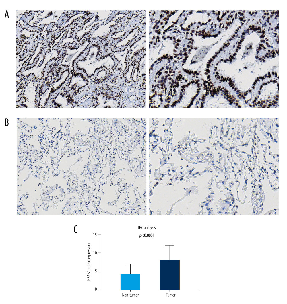 Immunohistochemistry of H2AFZ in the LUAD tissues and normal lung tissues. (A) Nuclear staining in LUAD tissues (left panel: 20×, right panel: 40×). (B) Cells in adjacent normal tissues are not stained (left panel: 20×, right panel: 40×). (C) Differential expression of H2AFZ protein in LUAD tissues and normal lung tissues. GraphPad Prism 7.0 software (GraphPad Software Inc., La Jolla, CA, USA).