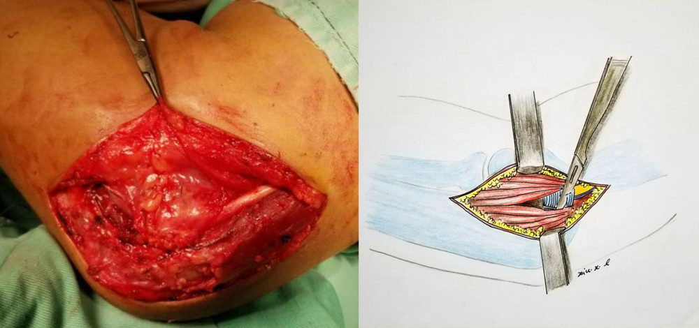 The ulnar nerve was decompressed and reincorporated into the enlarged cubital tunnel and the Osborne ligament was zig-zag elongated and reconstructed.