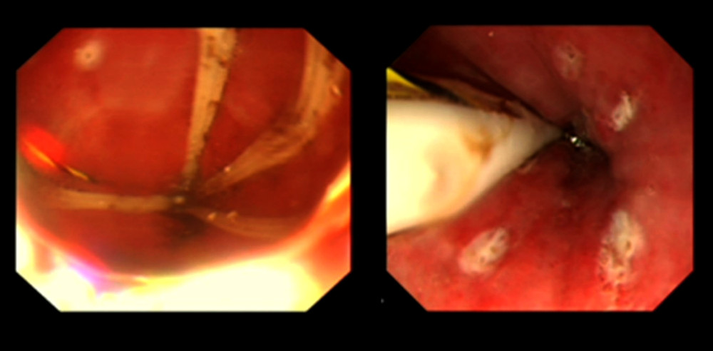 Images during and after endoscopic radiofrequency therapy under direct vision (Electronic gastroscope system GIH-Q260H, Olympus Corporation).