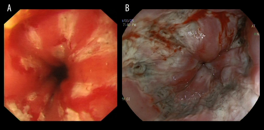 (A) Endoscopic images of endoscopic radiofrequency therapy under direct vision (Electronic gastroscope system GIH-Q260H, Olympus Corporation). (B) Endoscopic images of traditional non-direct radiofrequency therapy (Electronic gastroscope system EG-L600ZW7, Fujifilm Corporation).