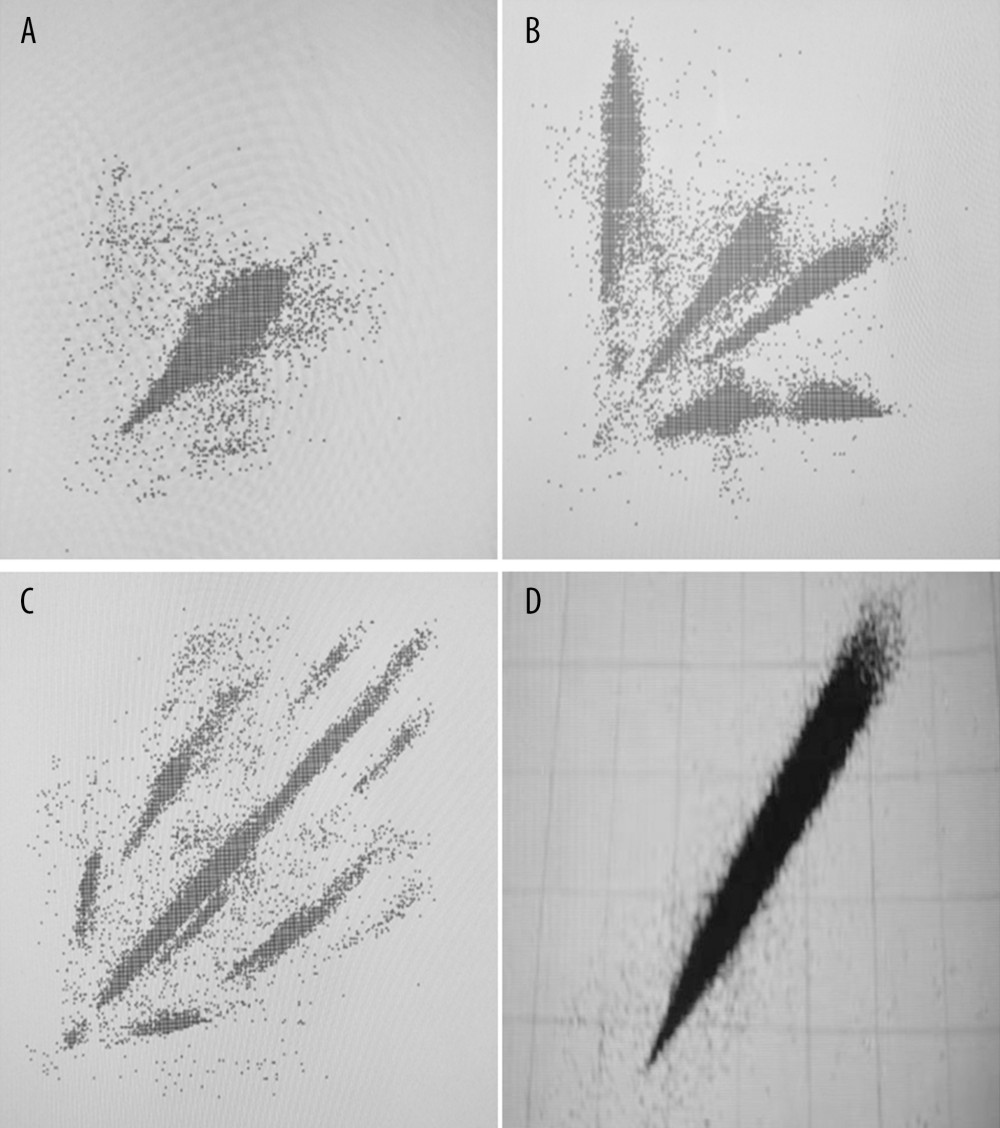 Poincaré dispersed-dot plot of PAF. (A) Oval shape, (B) spider shape, (C) irregular shape, (D) comet shape.