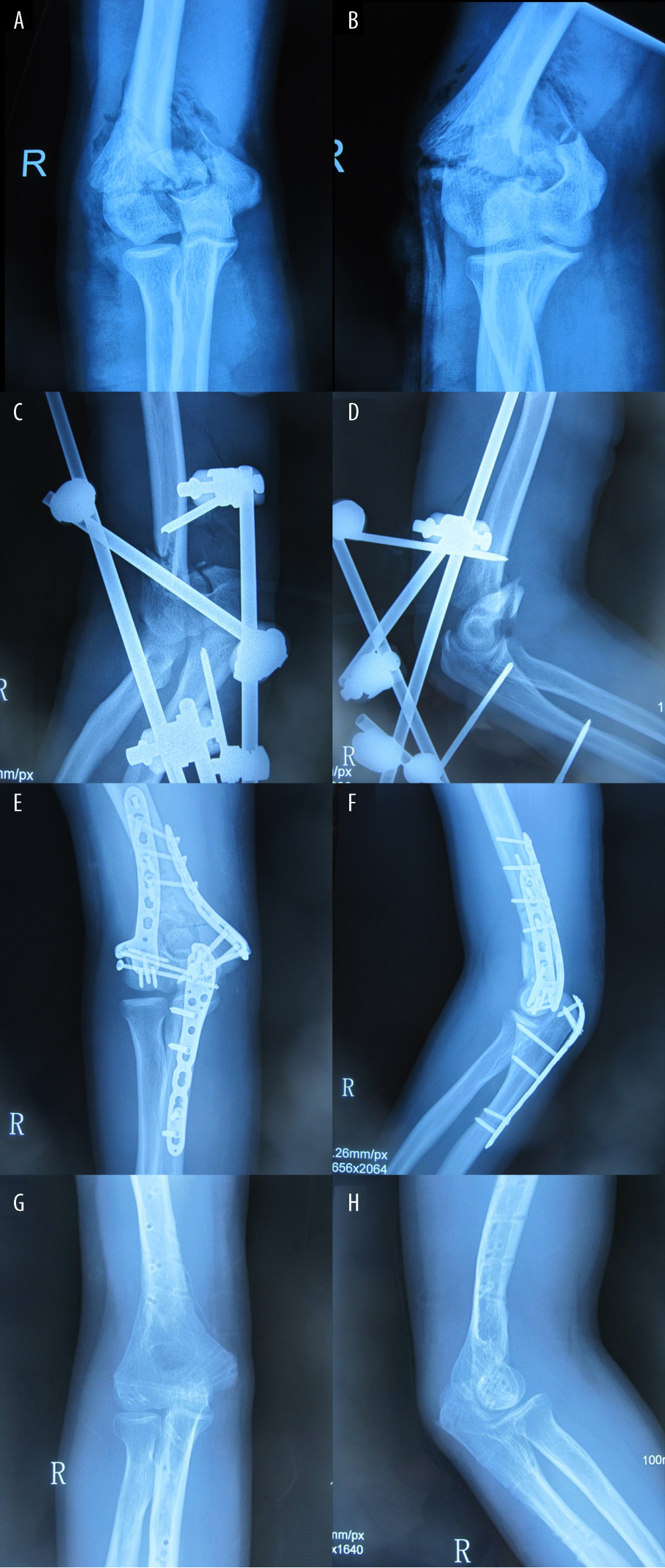 Radiographs from a 35-year-old man who had a grade II open distal humeral fracture in a motor vehicle accident. (A) Anteroposterior and (B) lateral radiographs of AO/OTA type 13-C2 intra-articular fracture of distal humerus on admission. (C) Postoperative anteroposterior and (D) lateral radiographs showing fractures of the distal humeral stabilized by uniplanar external fixation (EF) following debridement. (E) Anteroposterior and (F) lateral radiographs of plate fixation immediately after surgery. EF had been converted to a plate on day 10 after injury. (G) Anteroposterior and (H) lateral radiographs (the internal fixation plates were removed 1 year after plate fixation) showing excellent bony union.