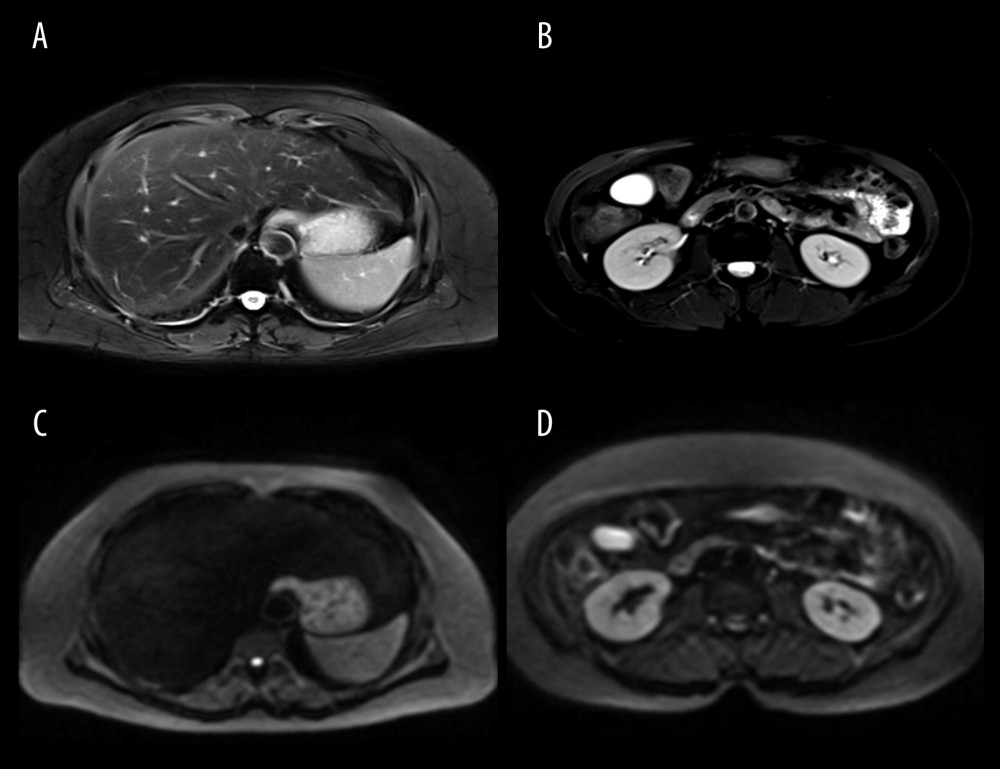 (A–D) Patients were diagnosed with advanced endometrial cancer by MRI. The figure was edited using Microsoft PowerPoint 2010 (Microsoft, Redmond, WA, USA) from a screenshot from the Medixant, RadiAnt DICOM Viewer (version 2020.2.3) in our institution.