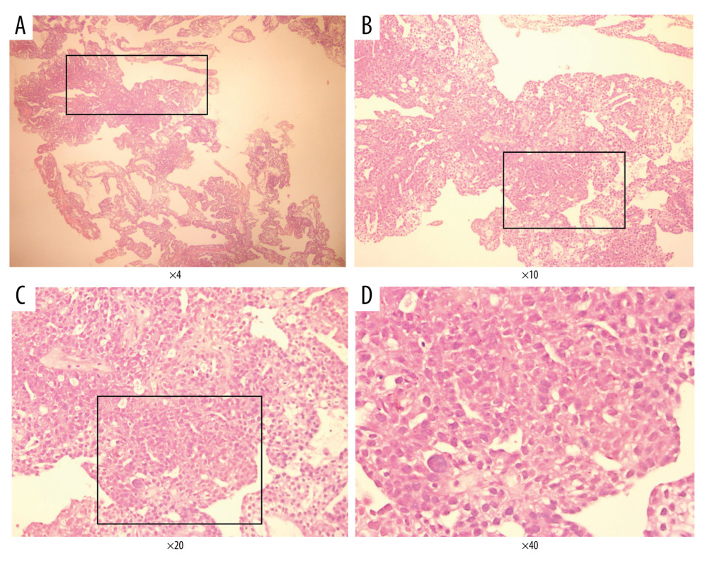 Endometrial cancer tissue samples were confirmed by histological analysis (H&E staining). A–D, represents different magnification (Magnification ×4, ×10, ×20, ×40). The Figure was created by Adobe Illustrator CC 2019, Adobe Systems Incorporated.