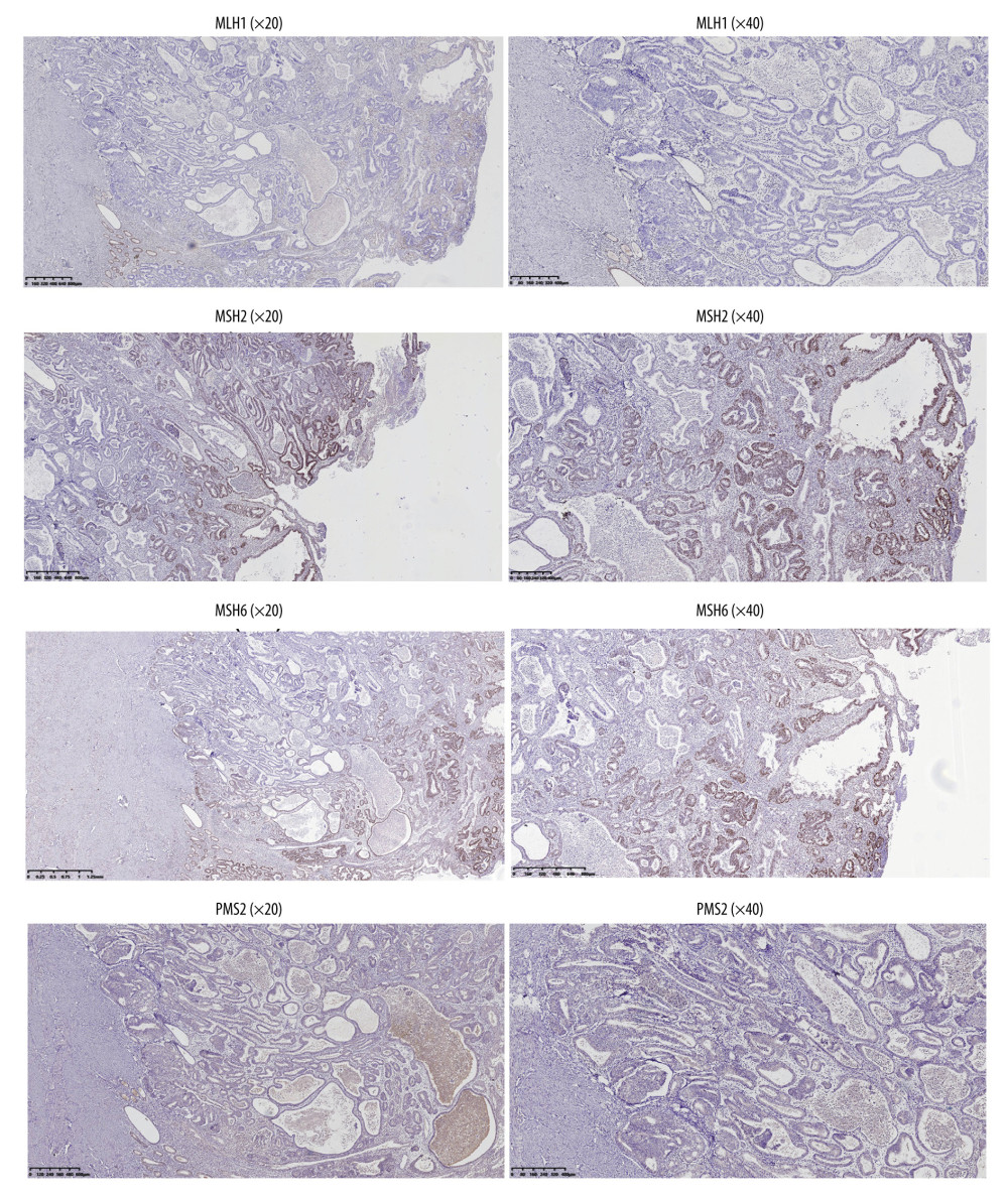 The dMMR proteins in endometrial cancer tissue samples were stained for immunohistochemistry. The figure was created using Adobe Illustrator CC 2019, Adobe Systems Incorporated.