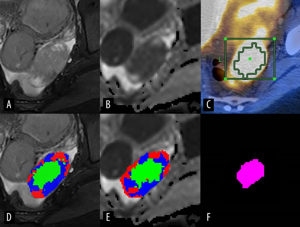 Representative case presenting the combined high-cellularity tumor volume (HCTVC) segmented by both T2-weighted imaging (T2WI) and diffusion-weighted imaging (DWI), as compared with the metabolic tumor volume (MTV) defined in positron emission tomography with computed tomography (PET/CT). (A) T2WI and (D) manually drawn region of interest (ROI), divided into 3 clusters. (B) Apparent diffusion coefficient (ADC) map and (E) manually drawn ROI, divided into 3 clusters. (C) PET/CT and manually drawn ROI, generated by using 45% maximum standard uptake value as the lower threshold. (F) The HCTVC was obtained by excluding low-intensity pixels on T2WI and high ADC pixels on ADC maps.