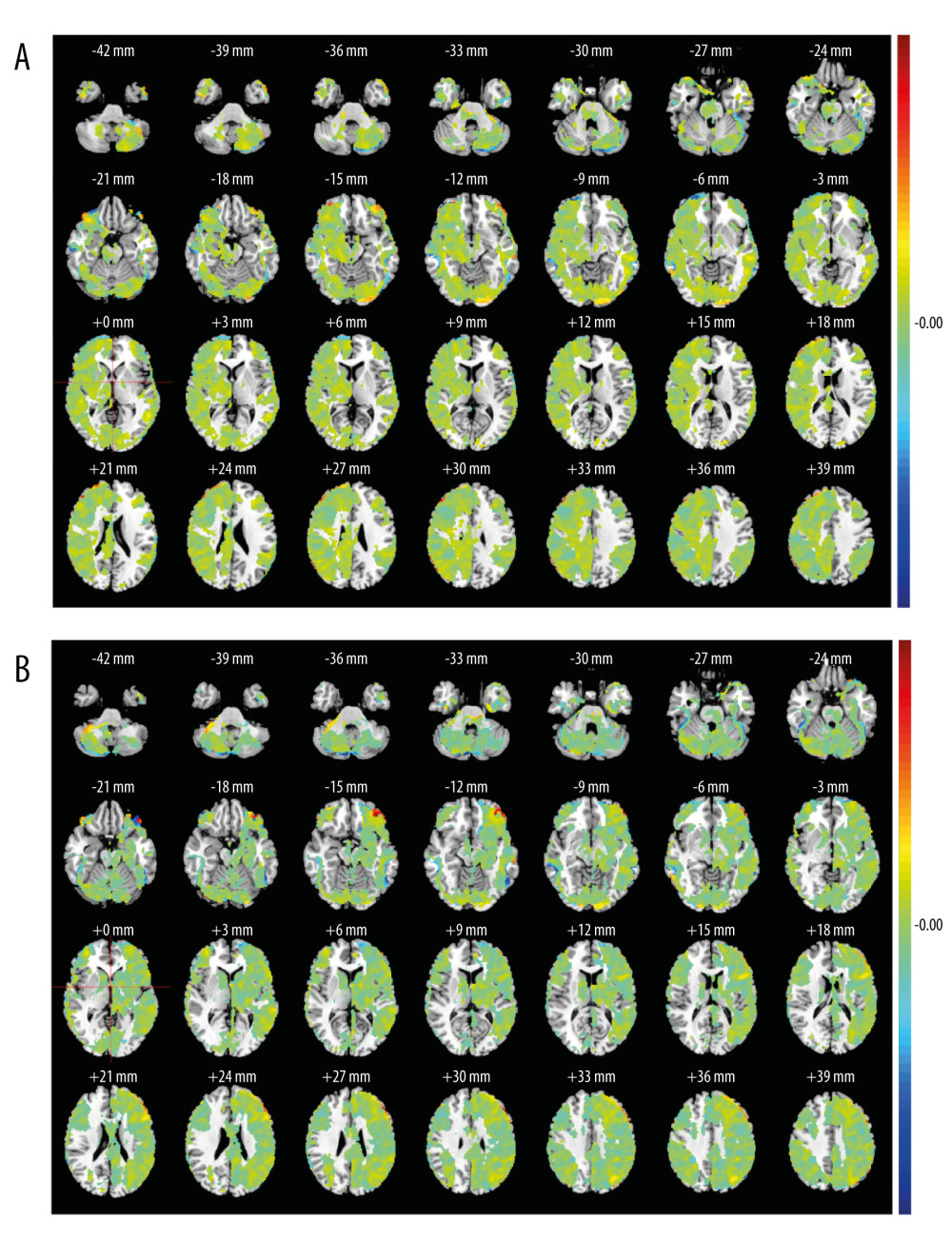 The selected resting-state frontoparietal network in this studyFPN included left FPN and right FPN. Left FPN (A) included the right inferior semilunar lobule, left fusiform gyrus, the orbital part of right inferior frontal gyrus, right parietal lobule, left supra-marginal gyrus, the left orbital middle frontal gyrus, right middle frontal gyrus, etc. Right FPN (B) included the left inferior semilunar lobule, right middle frontal gyrus, the orbital part of left inferior frontal gyrus, right parahippocampal gyrus, right supraoccipital gyrus, right superior marginal gyrus, etc. MATLAB R2017a (MathWorks, Inc., USA) was used to create this figure.