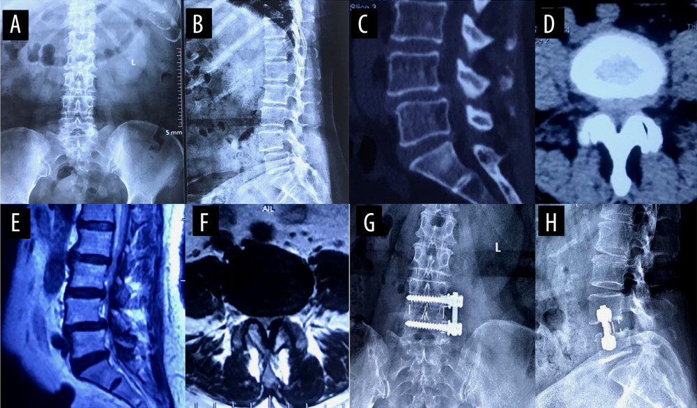 A typical case of oblique lateral interbody fusion with anterolateral screw fixation (OLIF+AF)A 65-year-old woman had low back pain for 4 years, aggravated for 3 months. OLIF+AF was employed to treat lumbar spondylolisthesis at L4/5. (A) Preoperative anteroposterior radiograph. (B) Preoperative lateral radiograph shows L4 vertebral body I° anterior spondylolisthesis and loss of intervertebral disc height at L4/5. Before surgery, the anterior disc height (ADH) was 5.3 mm, the posterior disc height (PDH) was 4.9 mm, and the foraminal height (FH) was 13.2 mm. (C) Preoperative sagittal computed tomography (CT). (D) Preoperative cross-section CT shows disc herniation, obvious proliferation of the ligamentum flavum, and spinal canal stenosis at L4/5. (E) Preoperative sagittal magnetic resonance imaging (MRI). (F) Preoperative cross-section MRI shows disc herniation, obvious proliferation of the ligamentum flavum, and spinal canal stenosis at L4/5. (G) Postoperative anteroposterior radiograph. (H) Postoperative lateral radiograph shows the intervertebral cage at L4/5 was well in place, and the ADH, PDH, and FH were significantly increased. After surgery, the ADH was 10.4 mm, the PDH was 9.7 mm, and the FH was 18.3 mm.