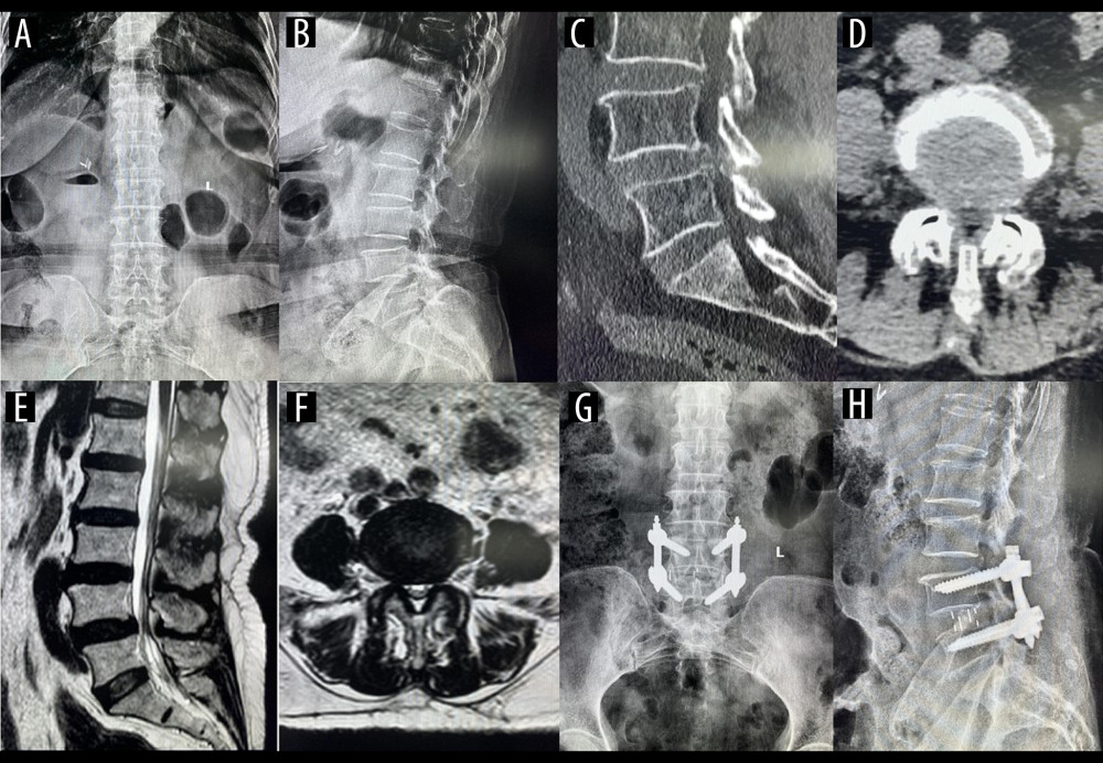 A typical case of oblique lateral interbody fusion with percutaneous pedicle screw fixation (OLIF+PF)A 57-year-old man had low back pain for 3 years, aggravated for 5 months. OLIF+PF was employed to treat lumbar spondylolisthesis at L4/5. (A) Preoperative anteroposterior radiograph. (B) Preoperative lateral radiograph shows L4 vertebral body I° anterior spondylolisthesis and loss of intervertebral disc height at L4/5. Before surgery, the anterior disc height (ADH) was 5.7 mm, the posterior disc height (PDH) was 5.1 mm, and the foraminal height (FH) was 13.9 mm. (C) Preoperative sagittal computed tomography (CT). (D) Preoperative cross-section CT shows disc herniation, obvious proliferation of the ligamentum flavum, and spinal canal stenosis at L4/5. (E) Preoperative sagittal magnetic resonance imaging (MRI). (F) Preoperative cross-section MRI shows disc herniation, obvious proliferation of the ligamentum flavum, and spinal canal stenosis at L4/5. (G) Postoperative anteroposterior radiograph. (H) Postoperative lateral radiograph shows the intervertebral cage at L4/5 was well in place, and the ADH, PDH, and FH were significantly increased. After surgery, the ADH was 11.2 mm, the PDH was 10.5 mm, and the FH was 19.1 mm.
