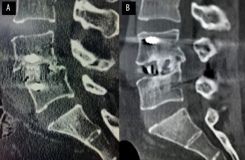 The typical case of postoperative fusion in the OLIF+AF and OLIF+PF groups(A) Postoperative sagittal computed tomography (CT) in OLIF+AF case shows intervertebral fusion with trabeculae reconstruction and no lucencies at the top or bottom of the graft at L4/5. (B) Postoperative sagittal CT in OLIF+PF case shows intervertebral fusion with trabeculae reconstruction and no lucencies at the top or bottom of the graft at L4/5.