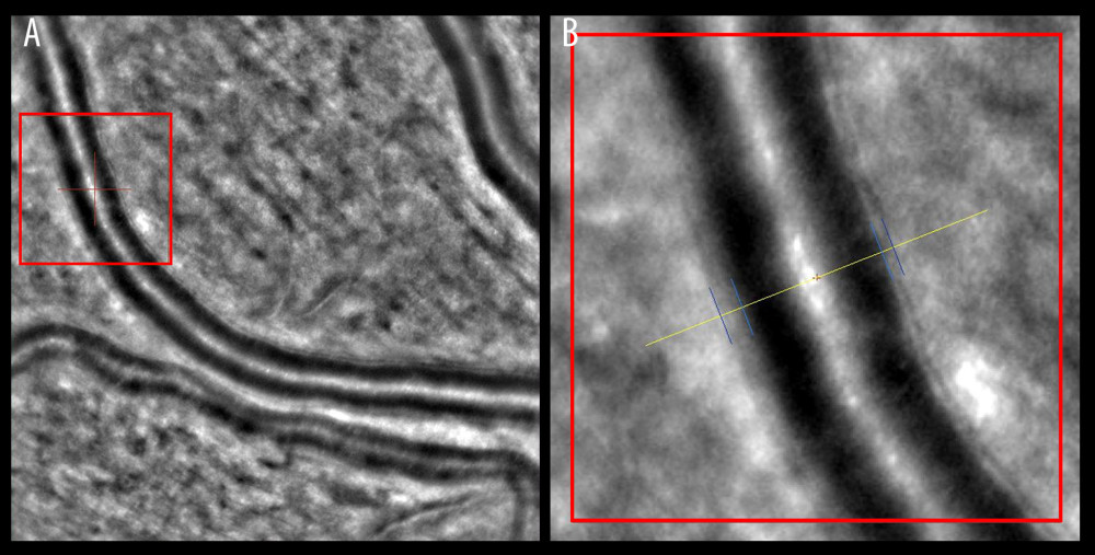 Wall-to-lumen ratio of patient without hypertension (0.240). (A) Image from rtx1 Adaptive Optics Retinal Camera. (B) Area in the red square enlarged. Figure was prepared in Microsoft PowerPoint 2019 (Microsoft Corporation).