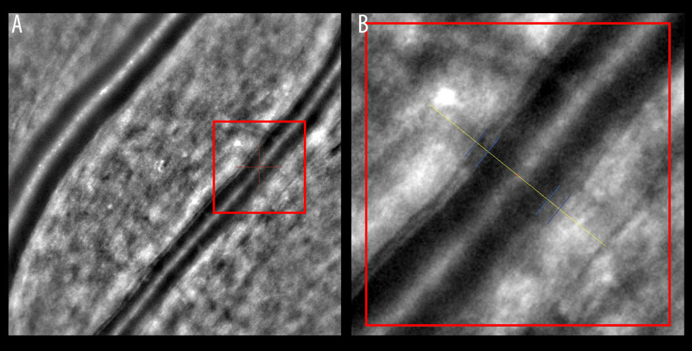 Increased wall-to-lumen ratio of patient with hypertension (0.370). (A) Image from rtx1 Adaptive Optics Retinal Camera. (B) Area in the red square enlarged. Figure was prepared in Microsoft PowerPoint 2019 (Microsoft Corporation).
