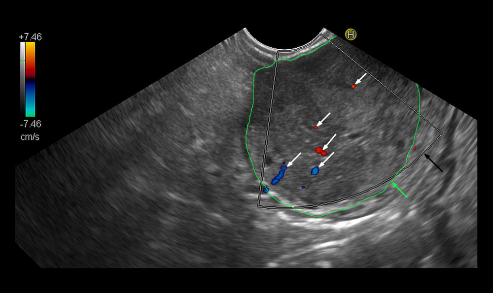 Endosonographic examination with color Doppler option of the malignant pancreatic lesion. Malignant tumor outlined with the green line (green arrow). The black arrow indicates the color Doppler frame. White arrows show sparse vessels detected in the color Doppler option. Calculated color Doppler vascularity index, 0.42%; tissue flow velocity, 1.63 cm/s; tissue perfusion intensity, 0.007 cm/s.