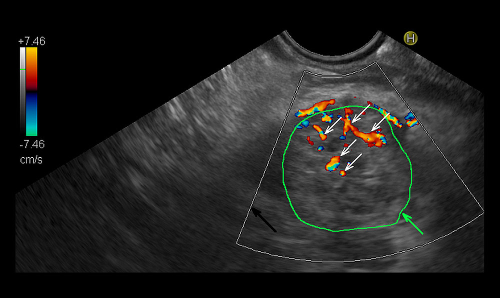 Endosonographic examination with color Doppler option of pancreatitis. Pancreatitis area outlined with the green line (green arrow). The black arrow indicates the color Doppler frame. White arrows show multiple vessels detected in the color Doppler option. Calculated color Doppler vascularity index, 5.97%; tissue flow velocity, 3.74 cm/s; tissue perfusion intensity, 0.220 cm/s.