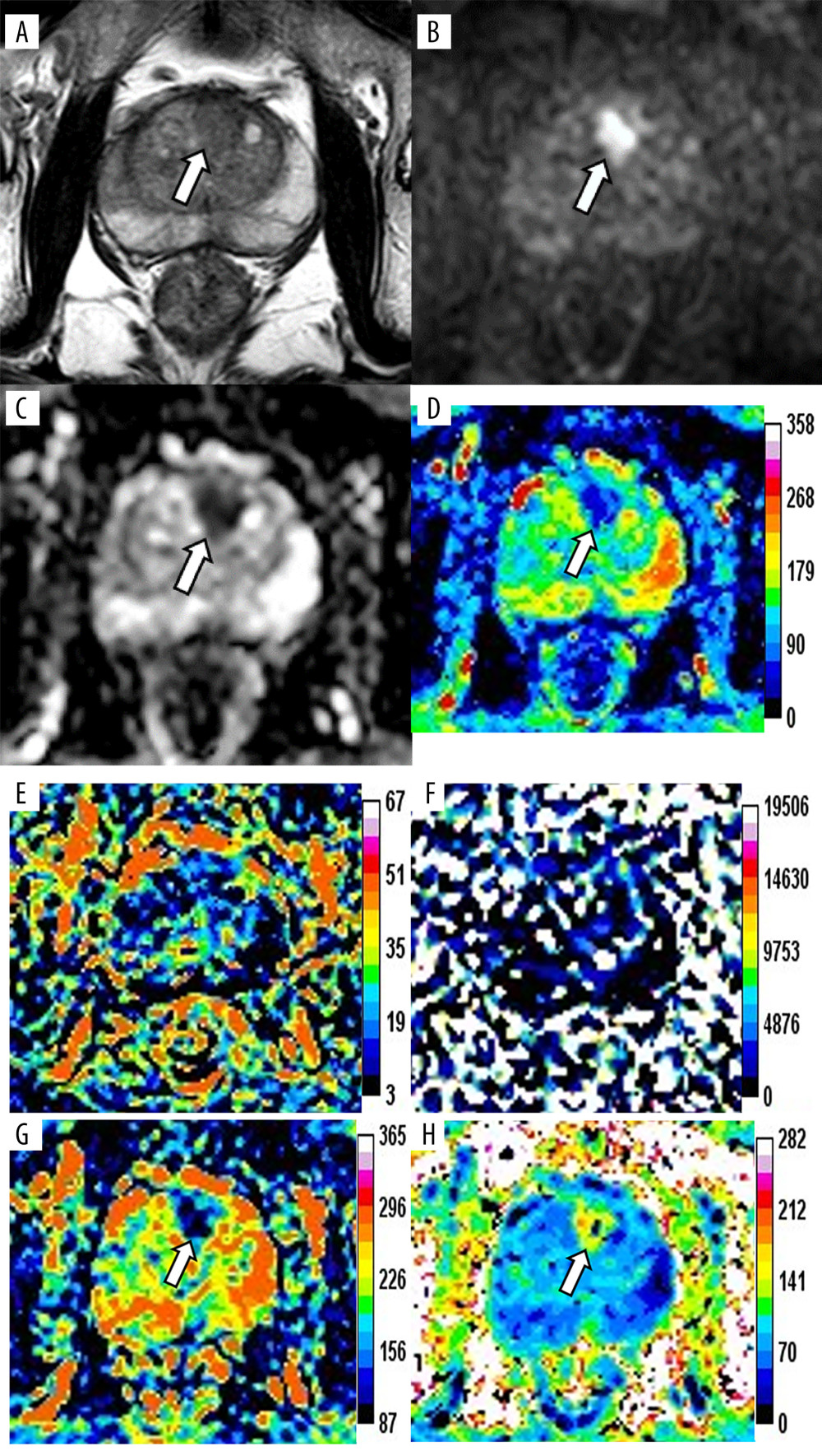 Magnetic resonance images of a 76-year-old patient with prostate cancer (PCa), total prostate-specific antigen (PSA) of 23.48 ng/mL, free/total PSA of 0.145, and PSA density of 0.34 ng/mL/cm3. The axis T2-weighted imaging (A) shows a low-signal area at the anterior of the transitional zone (white arrow). The lesion appears as a significantly high signal change on diffusion-weighted imaging (B, white arrow), whereas it appears as a low signal on apparent diffusion coefficient (ADC) (C, white arrow). The pseudo-color maps of D (D), Dapp (G), and Kapp (H) show the lesion clearly (white arrow). The image quality of f (E) and D* (F) are unsatisfactory. The parameter values of the lesion are 0.66×10−3 mm2/s (ADC), 0.64×10−3 mm2/s (D), 0.12 (f), 90.59×10−3 mm2/s (D*), 0.94×10−3 mm2/s (Dapp), and 1.19 (Kapp). The prediction probability (P) of the lesion being cancer can be calculated as follows:P=e(4.339+3.896×0.340-7.130×0.660)1+e(4.339+3.896×0.340-7.130×0.660)=72.2%. (Ingenia 3.0T,PHILIPS;PRIDE DWI Tool 1.5,PHILIPS;Image J 1.52a,NIH).