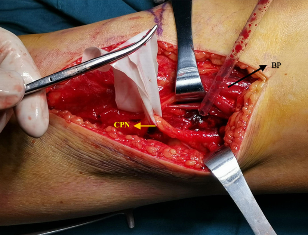 The process of isolating the common peroneal nerve (CPN). After the CPN was located, it was carefully dissociated at the rear edge of the biceps femoris muscle (BP, black arrow) and protected by the rubber belt. Figure was taken with an iPhone X (Apple, CA, USA) and edited via Microsoft Word (version 16.57, Microsoft, USA).