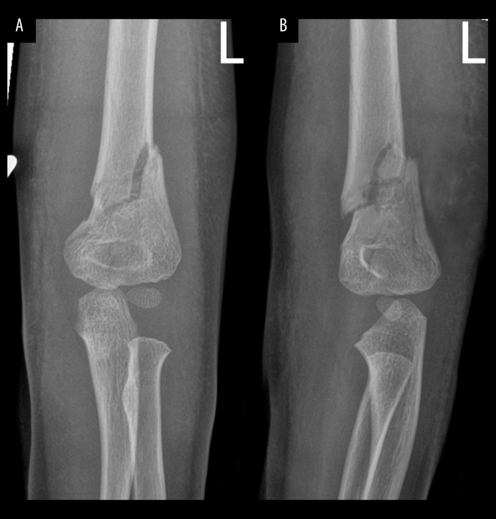 Pre-operative fluoroscopy of a 4-year-old boy with left distal humerus metaphyseal-diaphyseal junction (DMJ) fracture (Case 1). (A) Pre-operative anteroposterior fluoroscopy of left distal humerus. (B) Pre-operative lateral fluoroscopy of left distal humerus.