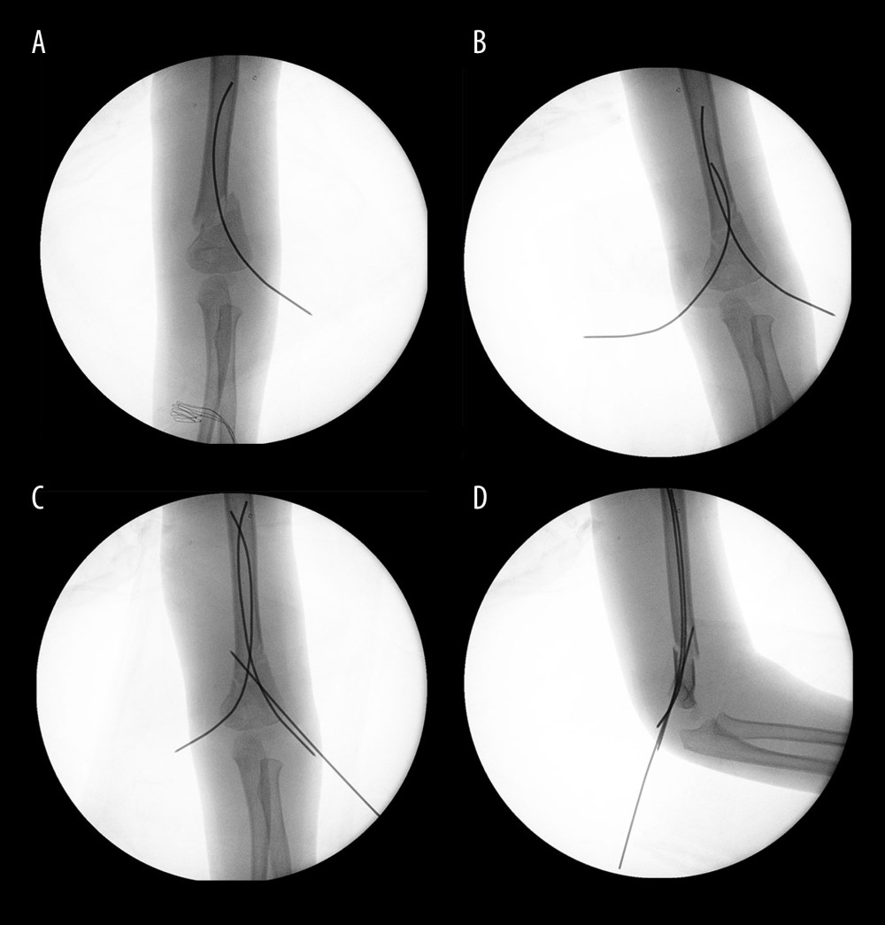 Surgical procedures of closed reduction percutaneous intramedullary fixation with Kirschner wire for Case 1. (A) The first pre-bent Kirschner wires was inserted into the lateral epicondyle of the humerus. (B) Another pre-bent Kirschner wires was inserted into the medial epicondyle of the humerus. (C, D) The third Kirschner wire was placed in a retrograde direction into the lateral side of distal humerus and passed through the contralateral bone cortex to achieve anti-flexion/extension and rotation-stable fixation. Intra-operative fluoroscopy showed satisfactory fracture reduction.