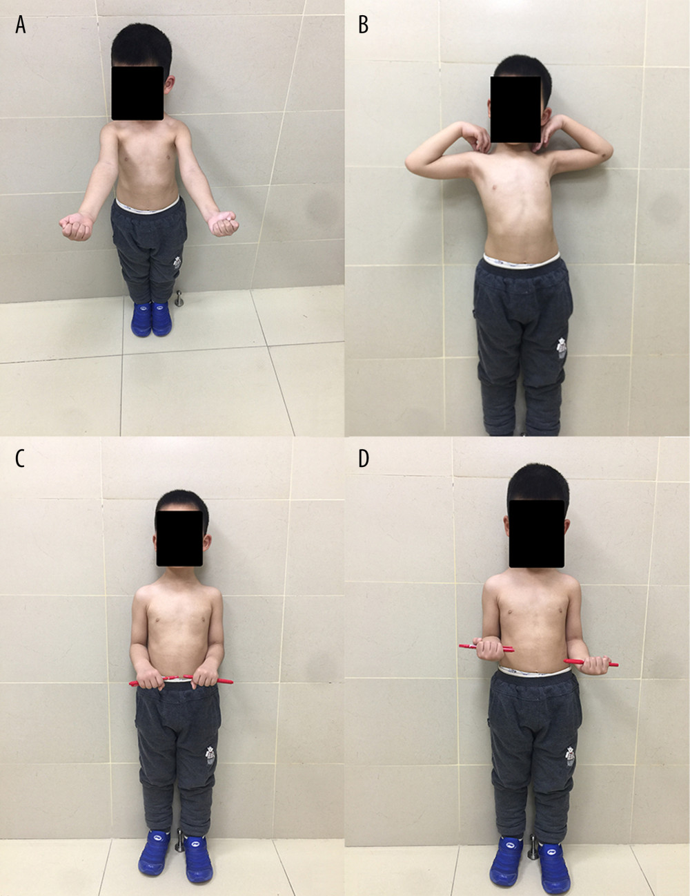 Clinical outcome at the last follow-up showed excellent function. (A, B) Elbow joint has normal flexion and extension function. (C, D) Elbow joint has normal pronation and supination function.