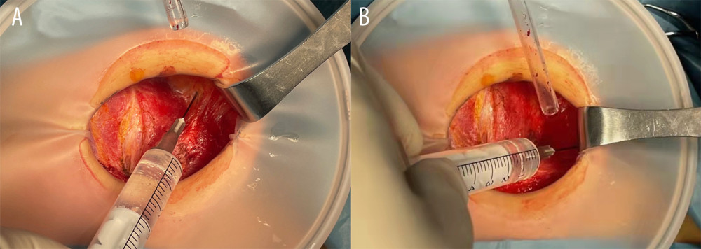 (A, B) Intraoperative precision nerve block was administered through the wound for postoperative analgesia. In the precision group, 0.3% ropivacaine (1.5 mL for each nerve) was used through the wound during surgery. At the deep level of the platysma muscle, the ropivacaine was firstly injected upward along the front edge of the sternocleidomastoid muscle to block the lower branch of the transverse cervical nerve, and then was injected along the anterolateral direction of the sternocleidomastoid muscle to block the inner branches of the supraclavicular nerve.