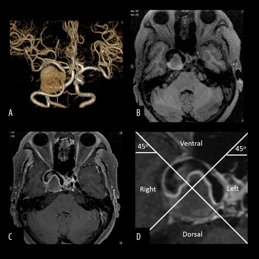 A thrombi aneurysm in the cavernous sinus segment of the right internal carotid artery of a 67-year-old woman. (A) Three-dimensional time of flight magnetic resonance angiography (3D-TOF-MRA) showing an aneurysm in the cavernous sinus segment of the right internal carotid artery with a size of 3.4 cm and aspect ratio value of 4.1, the shape of the aneurysm is irregular, and filling defects are seen in the aneurysm. (B) Axial T1WI image from the Philips 3D high-resolution magnetic resonance imaging (HR-MRI) scanner showing irregular isointense thrombosis in the aneurysm. (C) Axial T1WI enhanced image from the Philips 3D HR-MRI scanner showing diffused enhancement of the aneurysm wall and thrombus surface. (D) Enlarged view of the aneurysm in (C) showing the aneurysm divided into 4 quadrants (left, right, ventral, and dorsal) with 2 intersecting lines at the center of the aneurysm, and the thrombus located on the dorsal side of the aneurysm. All images were analyzed by GE adw 4.5 post-processing workstation.