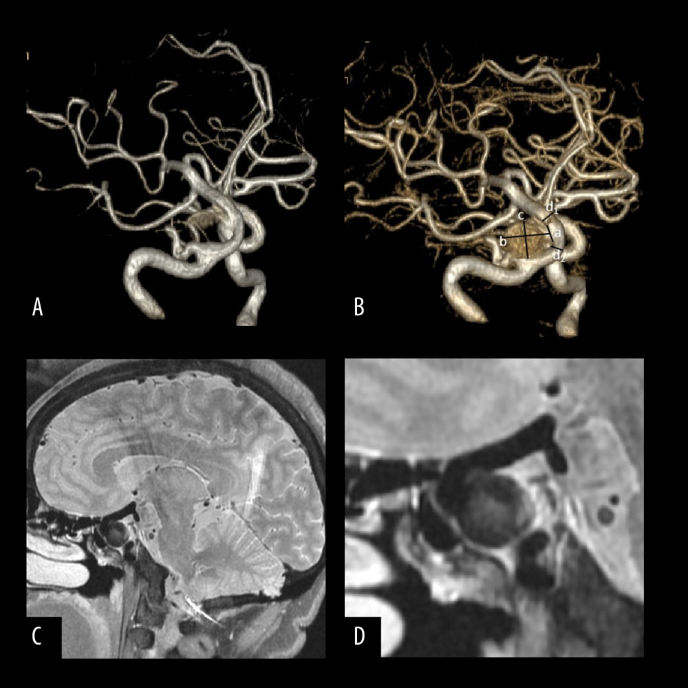 A thrombotic aneurysm on the posterior communicating artery of the right internal carotid artery of a 51-year-old man. (A) Initial reconstructed virtual reality image of 3-dimensional time of flight magnetic resonance angiography (3D-TOF-MRA) showing a right internal carotid artery posterior communicating initiating aneurysm, but not maximal visualization of the aneurysm. (B) On the basis of Figure A, the virtual reality image with a larger window width showing the aneurysm to the greatest extent, and displaying the rough and uneven shape of aneurysm with a size of 2.1 cm and aspect ratio value of 2.9. Line (a) represents the aneurysm neck; line (b) represents the height of the aneurysm; line (c) represents the width of the aneurysm; (d1) and (d2) represent the diameter of the aneurysm parent artery related to the aneurysm; that is, the largest parent within 5 mm from the proximal aneurysm neck. (C) Sagittal T2WI image from the GE 2D HR-MRI scanner showing the uneven hypointense thrombus spreading from the aneurysm body to the neck. (D) Enlarged view of (B) showing the morphology and distribution of the thrombus within the aneurysm neck. All images were analyzed by GE adw 4.5 post-processing workstation.