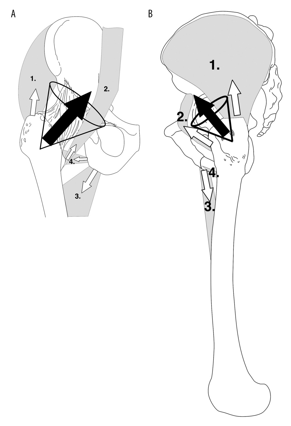 (A, B) Schematic presentation of the net force of the main muscle groups (gluteal (1), iliopsoas (2), adductors (3) and represented together piriformis, quadrature femoris, both obturatory and both gemmeli (4)) acting over the proximal femur. Anteroposterior (A) and lateral (B) views.