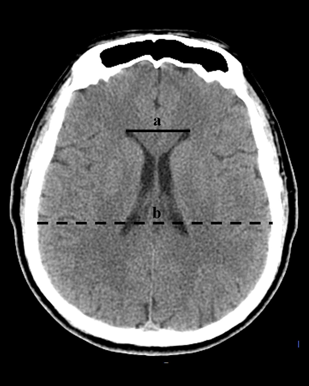 The diagnosis of hydrocephalus was performed by using an Evan index method. The distance between the frontal horns of the lateral ventricles (full line indicated with ‘a’) and the longest inner diameter of skull at the same plane (dotted line indicated with ‘b’). The Evans index was calculated as the ratio of a to b. (Adobe Photoshop CC, 14.0, Adobe).