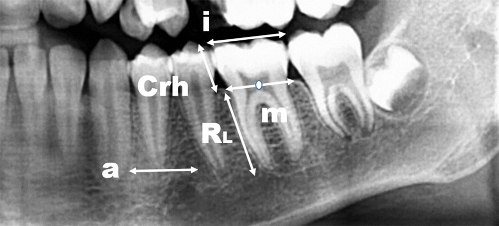 Radiographic landmarks used to measure root (length) and crown (height) in the assessment of the root-crown (R/C) ratio. a – apical level, i – incisal/occlusal reference line, RL – root length, Crh – crown height, m – the midpoint of the line connecting the mesial and distal proximal bone. Root length in mm=measured perpendicular from point m to point a. Crown height in mm=measured perpendicular from point m to i. (Figure created using MS Paint, version 20H2 (OS build 19042,1466), MS PowerPoint, windows 10 Pro, Microsoft corporation).