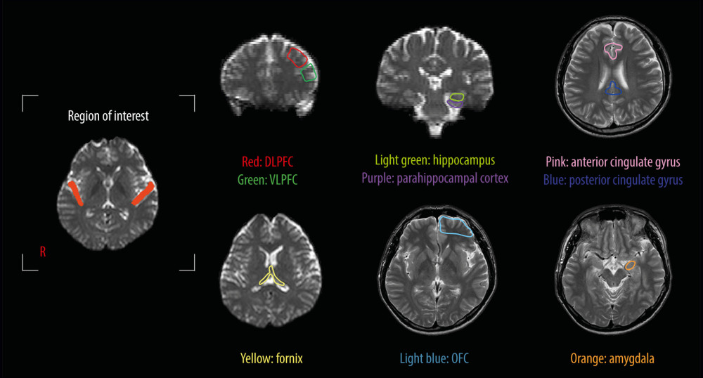 Region of interest and the cognition-related brain areas. Region of interest: the primary auditory cortex. The cognition-related brain areas: the dorsolateral prefrontal cortex (DLPFC), ventrolateral prefrontal cortex (VLPFC), anterior and posterior cingulate gyri, orbitofrontal cortex (OFC), amygdala, hippocampus, and parahippocampal cortex.