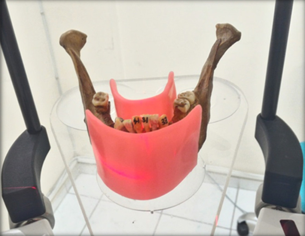 When the CBCT machine became ready to expose, 2-ply modeling waxes were placed buccally and lingually to imitate soft tissues and then the jaws were exposed. (Romexis viewer 3.0.2, Planmeca.).