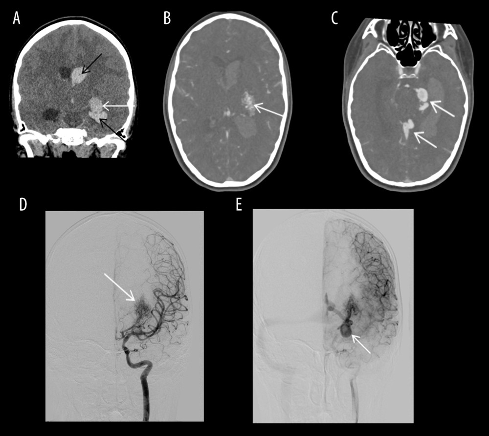 Acute parenchymal and intraventricular hemorrhage in a patient with arteriovenous malformation (Patient 9)(A) CT image in coronal plane: acute parenchymal (white arrow) and intraventricular hemorrhage (black arrows). (B) Intracranial CT angiography: Arteriovenous malformation (AVM) nidus (arrow). (C) Intracranial CT angiography: dilated draining veins (arrows). (D) DSA arterial phase: AVM nidus with feeding anterior choroidal artery. (E) DSA early venous phase: dilated veins draining to the deep venous system.