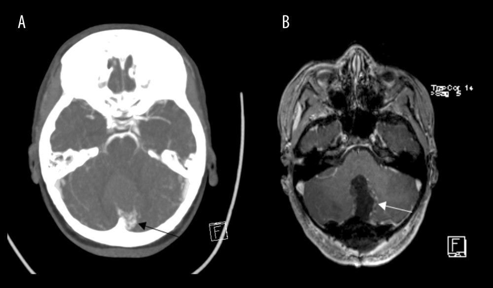 Complete obliteration of arteriovenous malformation after surgical treatment (Patient 8)(A) CT image in transverse plane; small arteriovenous malformation (AVM) in the left parasagittal infratentorial region (arrow). (B) MRI T1 CE sequence in transverse plane; complete surgical resection of the AVM (arrow).