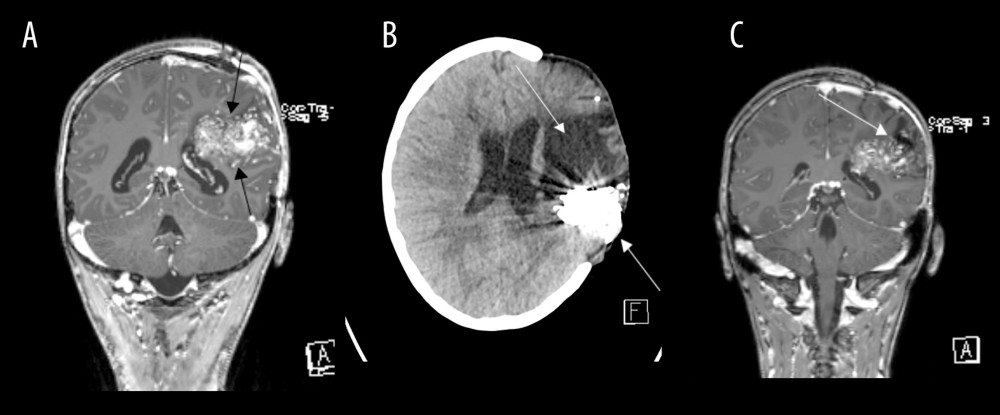Partial occlusion of arteriovenous malformation after endovascular embolization (Patient 5)(A) MRI T1 CE sequence in coronal plane: Large arteriovenous malformation (AVM) in the left frontoparietal region (arrows). (B) CT in transverse plane; hyperdense embolization material (arrow) posterior to large area of encephalomalacia after parenchymal hematoma (arrow). (C) MRI T1 CE sequence in coronal plane; partially occluded AVM (arrow).