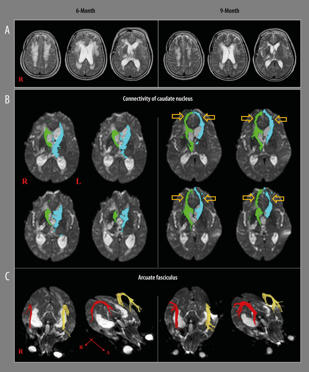 A patient who shows recovery from akinetic mutism and injured prefronto-caudate tract following shunt operation for hydrocephalus and rehabilitation. (A) T2-weighted brain magnetic resonance images at 6 months after onset, showing leukomalactic lesions in both fronto-parieto-occipital areas, right thalamus, and hydrocephalus, and relief of hydrocephalus at 9 months after onset. (B) On 6-month diffusion tensor tractography (DTT), the neural connectivity of the caudate nucleus to the medial prefrontal cortex (Broadmann area: 10 and 12) and orbitofrontal cortex (Broadmann area 11 and 13) is decreased in both hemispheres. However, the neural connectivity of the caudate nucleus to the medial prefrontal cortex is increased on both sides (arrows) on 9-month DTT. (C) The integrity of arcuate fasciculus is preserved in both hemispheres on both 6- and 9-month DTTs. (Reprinted with permission from Medicine, Medicine [Baltimore]: 2017; 96: e9117).