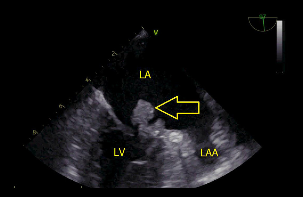 Transesophageal echocardiography. Vegetations of the mitral valve (indicated by yellow arrow). The image was acquired using a VIVID5S, General Electrics phased array ultrasonoscope (Tirat Carmel, Israel). LV – left ventricle; LA – left atrium.