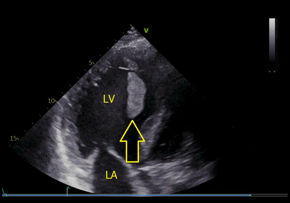 Transthoracic echocardiography. Thrombus in the left ventricle (indicated by yellow arrow). The image was acquired using a VIVID5S, General Electrics phased array ultrasonoscope (Tirat Carmel, Israel). LV – left ventricle.