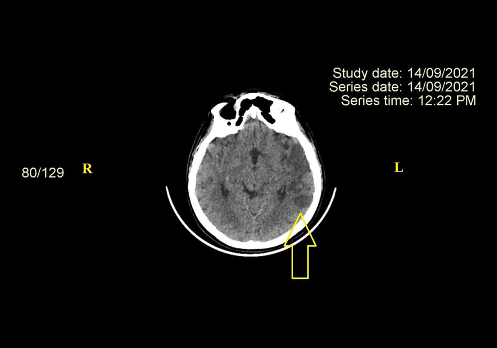 CT scan. Ischemic stroke in left superficial MCA territory (indicated by yellow arrow). The image was acquired using GE REVOLUTION EVO 128 SLICE computed tomograph produced by General Electric Healthcare Japan Corporation – Japan. CT – computed tomography; MCA – middle cerebral artery, R – right; L – left.