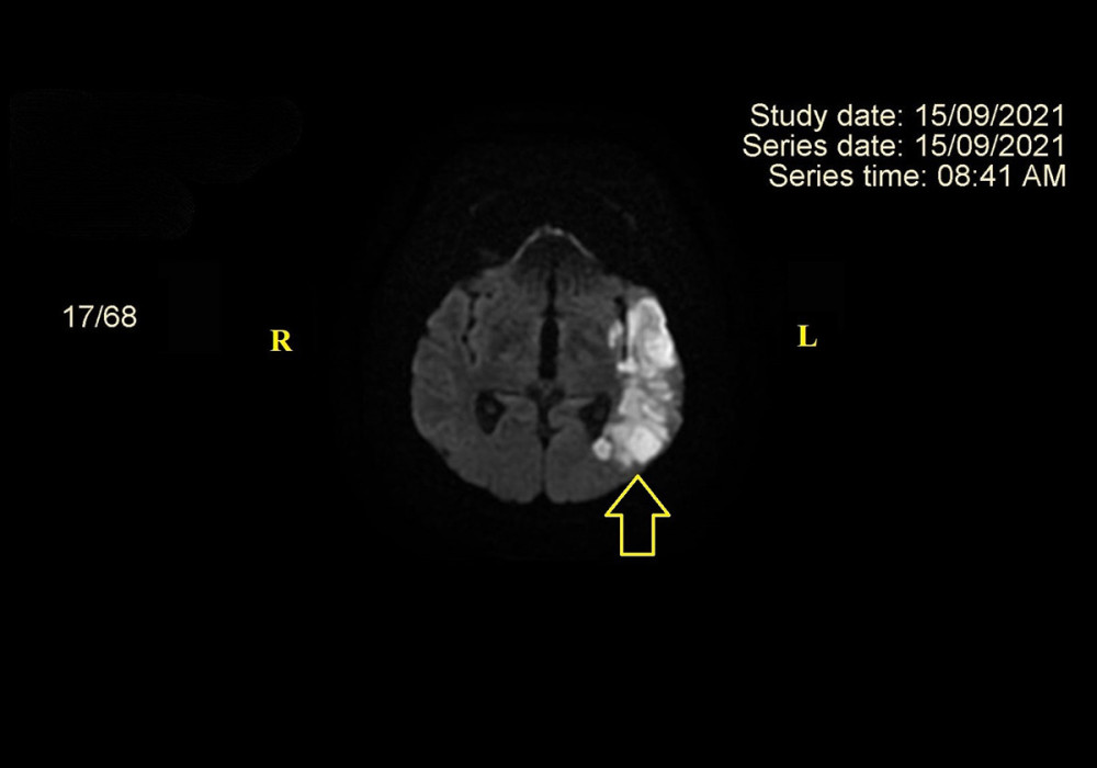 MRI in DWI. Recent ischemic stroke in superficial left MCA (indicated by yellow arrow). The image was acquired using GE SIGNA EXPLORER 1.5T magnetic resonance imaging device produced by General Electric Healthcare Japan Corporation – Japan. MRI – magnetic resonance imaging; DWI – diffusion-weighted imaging; R – right; L – left.