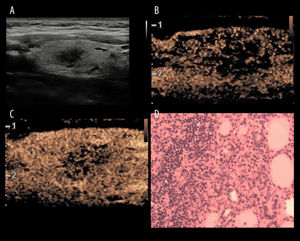 A inflammatory lesion in a 35-year-old woman. (A) Greyscale ultrasound showed that there was a solid very hypoechoic lesion in the left lobe of the thyroid, with irregular margin and a wider-than-tall shape. The nodule was C-TIRADS category 4c.(B) Contrast-enhanced ultrasound showed diffused and synchronous enhancement within the nodule at the time of the10th second after the injection of contrast agent. (C) Contrast-enhanced ultrasound showed hypo-enhancement and heterogeneity at peak (the 15th second after the injection of contrast agent), with irregular morphology. The CUES score of the lesion was −1. (D) The pathological image of the lesion, which was of subacute thyroiditis. Figure 3 was produced by PowerPoint version 2016(Microsoft corporation, WA, USA).