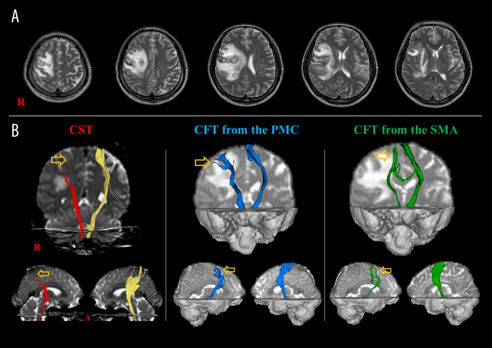 Patient who shows injuries for the corticospinal tract (CST) and corticofugal tracts (CFTs) in the right hemisphere. (A) T2-weighted brain MR images show a hemorrhagic lesion located in the right hemisphere. (B) Diffusion tensor tractography for the CST and CFTa from the premotor cortex (PMC) and supplementary motor area (SMA). The integrities of the CST, the CFT from the PMC, and the CFT from the SMA are preserved in both hemispheres. However, the CST, the CFT from the PMC, and the CFT from the SMA are thinner than those of the left side, respectively (reprinted with permission from American Journal of Physical Medicine and Rehabilitation: 2016;95:e115–116).