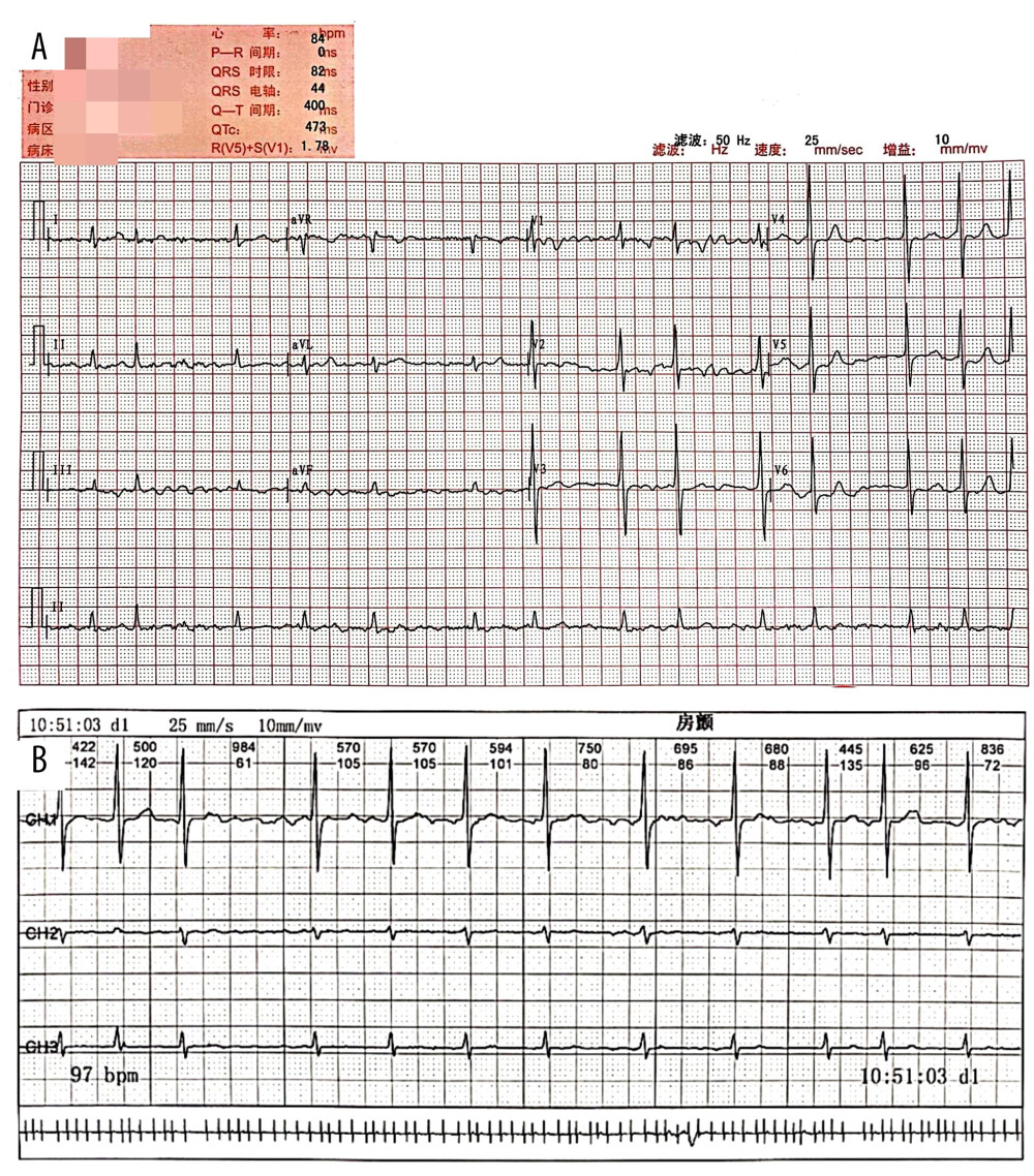 ECG and Holter in the detection of atrial fibrillation. (A) A representative ECG showing atrial fibrillation rhythm from a patient with permanent atrial fibrillation. (B) A selected segment of a representative Holter showing atrial fibrillation rhythm from a patient with paroxysmal atrial fibrillation.