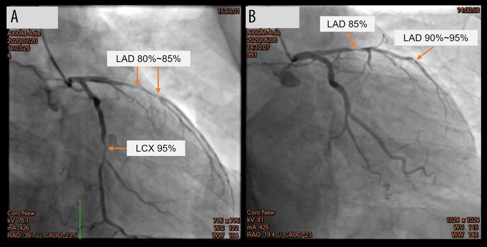 Coronary angiography (CAG) in the detection of coronary artery disease. (A) Shows 80~85% stenosis (red arrow) in the proximal and mid-segment left anterior descending (LAD) and 95% stenosis (red arrow) in the proximal segment of left circumflex artery (LCX). (B) Shows 85% stenosis (red arrow) in the proximal segment of LAD and 90~95% stenosis (red arrow) in the mid-distal segment of LAD.