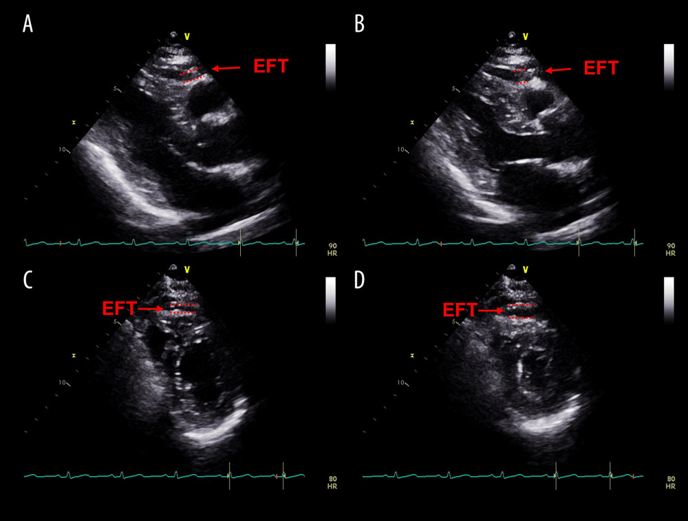 The measurement of epicardial fat thickness (EFT) by echocardiography in a patient with sinus rhythm. Epicardial fat appears as an echo-free space between the red dashed lines. (A) EFT measured during end-diastole in the parasternal long-axis view. (B) EFT measured during end-systole in the parasternal long-axis view. (C) EFT measured during end-diastole in the parasternal short-axis view. (D) EFT measured during end-systole in the parasternal short -axis view.