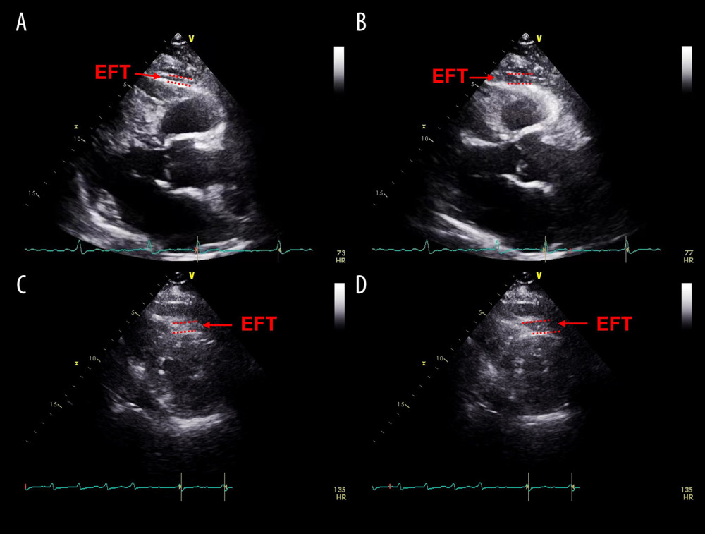 The measurement of epicardial fat thickness (EFT) by echocardiography in a patient with atrial fibrillation. Epicardial fat appears as an echo-free space between the red dashed lines. (A) EFT measured during end-diastole in the parasternal long-axis view. (B) EFT measured during end-systole in the parasternal long-axis view. (C) EFT measured during end-diastole in the parasternal short-axis view. (D) EFT measured during end-systole in the parasternal short -axis view.