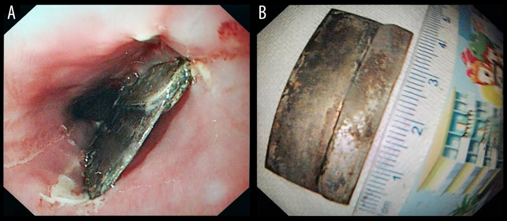 Sharp-pointed object (single-edge razor blade) before and after endoscopic removal. (A) Single-edge blade in the esophagus; (B) Removed single-edge blade. Endoscopic images were recorded during procedures and edited via Microsoft PowerPoint (version 2016, Microsoft, USA).