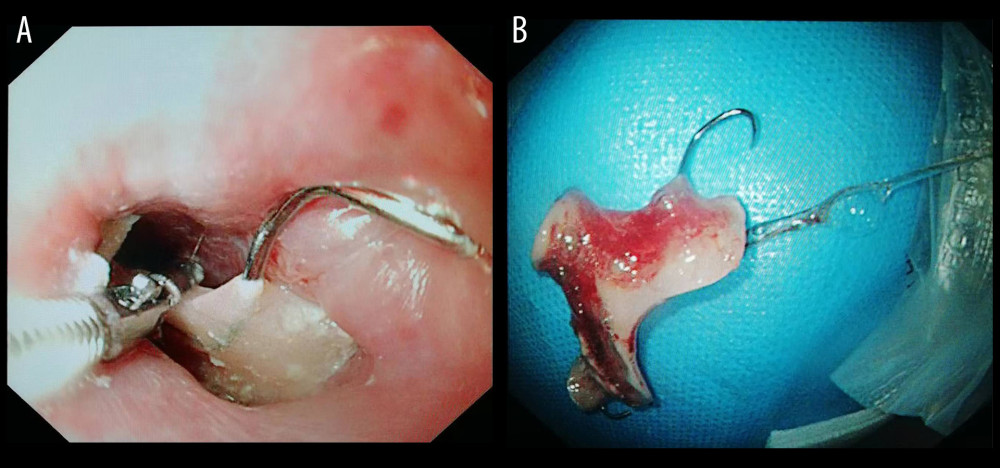 Sharp-pointed object (denture) before and after endoscopic removal. (A) Denture in the esophagus; (B) Removed denture. Endoscopic images were recorded during procedures and edited via Microsoft PowerPoint (version 2016, Microsoft, USA).