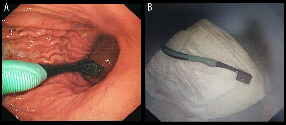 Long object (toothbrush) before and after endoscopic removal. (A) Toothbrush in the stomach; (B) Removed toothbrush. Endoscopic images were recorded during procedures and edited via Microsoft PowerPoint (version 2016, Microsoft, USA).