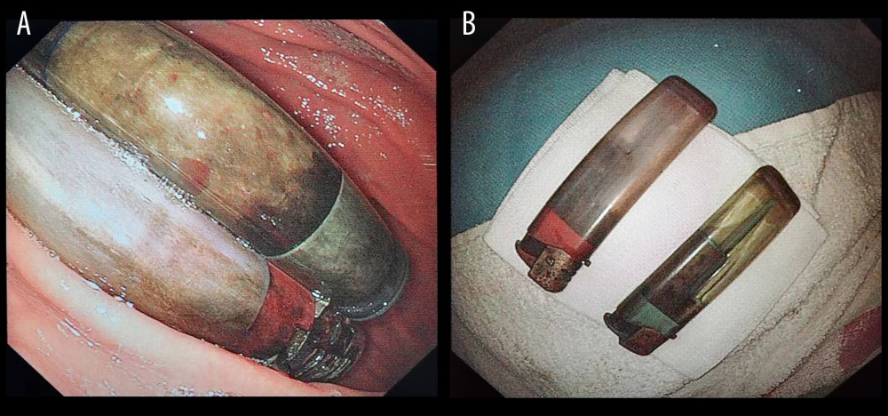 Long objects (lighters) before and after endoscopic removal. (A) Lighters in the stomach; (B) Removed lighters. Endoscopic images were recorded during procedures and edited via Microsoft PowerPoint (version 2016, Microsoft, USA).