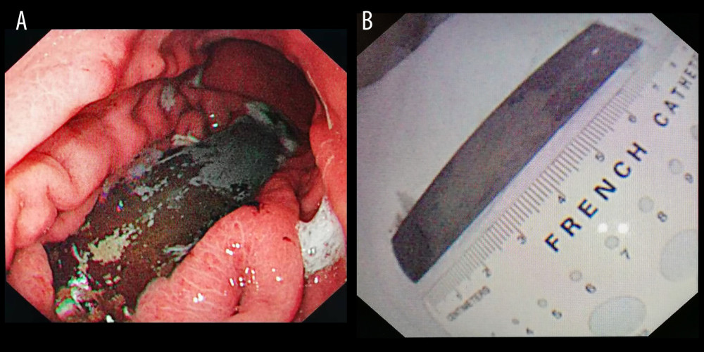Long object (steel plate) before and after endoscopic removal. (A) Steel plate in the stomach; (B) Removed steel plate. Endoscopic images were recorded during procedures and edited via Microsoft PowerPoint (version 2016, Microsoft, USA).